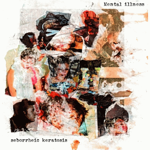 Seborrheic Keratosis : Mental Illness